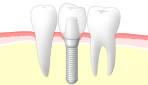 インプラント