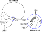 顎関節症