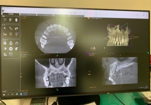 歯科用CT