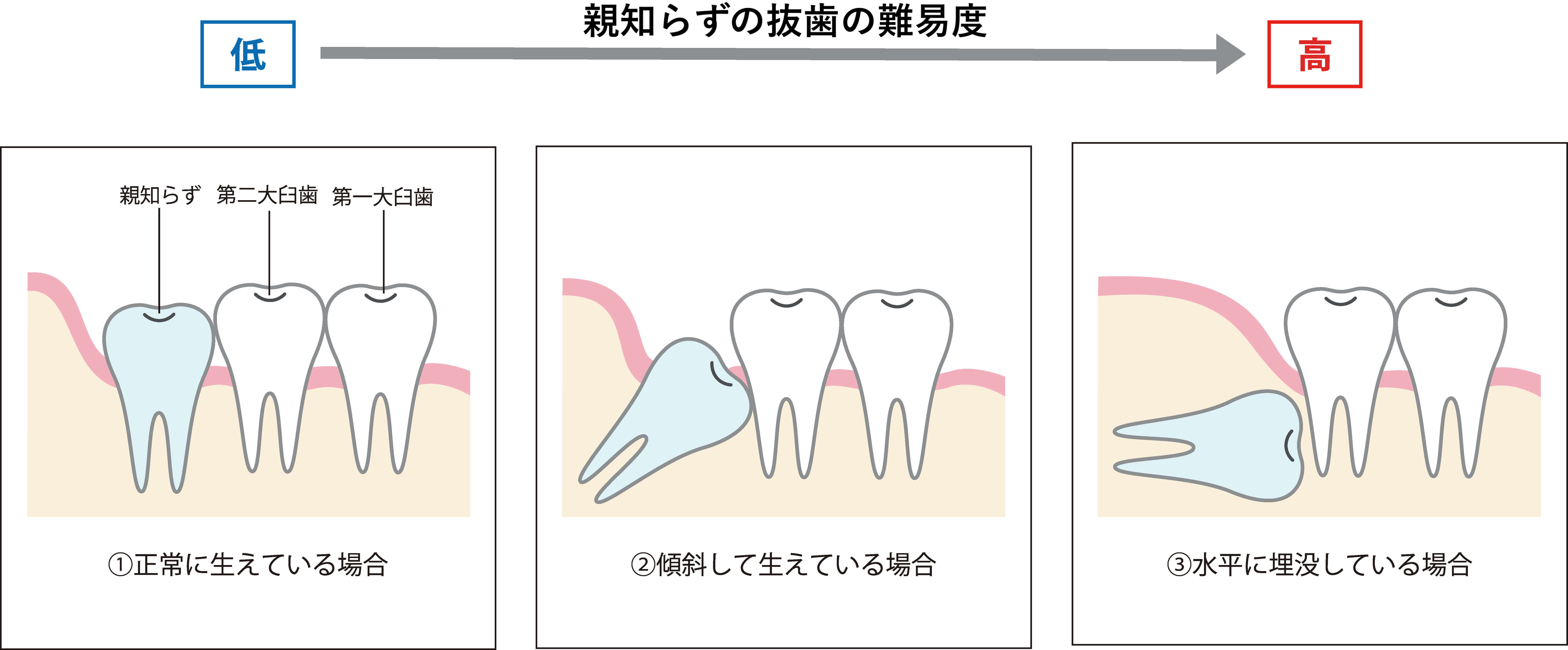 親知らずの抜歯の難易度