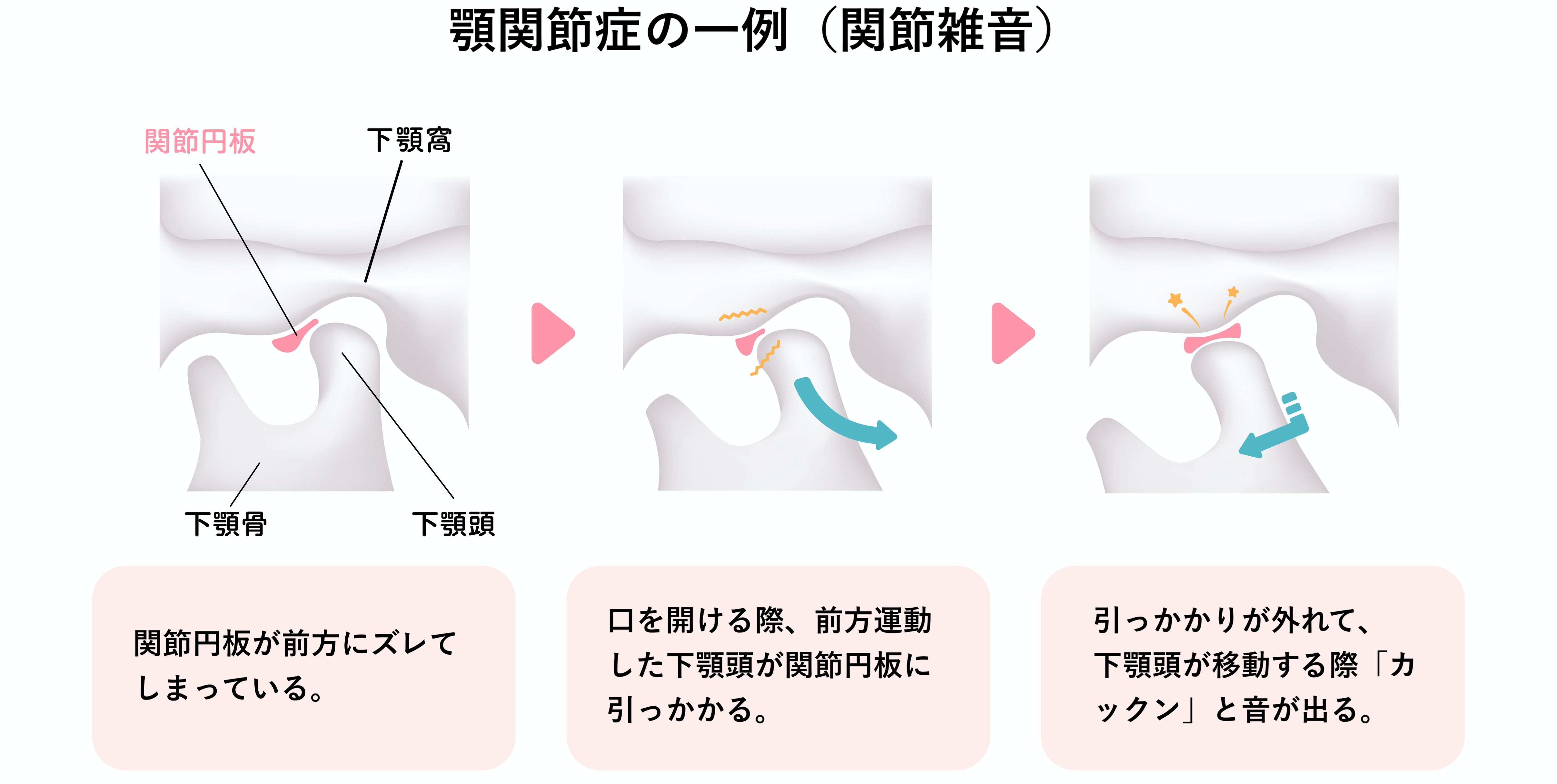 顎関節症の一例（関節雑音）